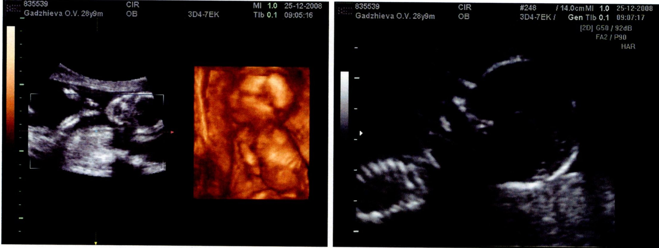 Узи 40 недель. 3д УЗИ на 16 неделе беременности. 3 Д УЗИ 15 недель беременности. УЗИ 16 недель беременности фото.