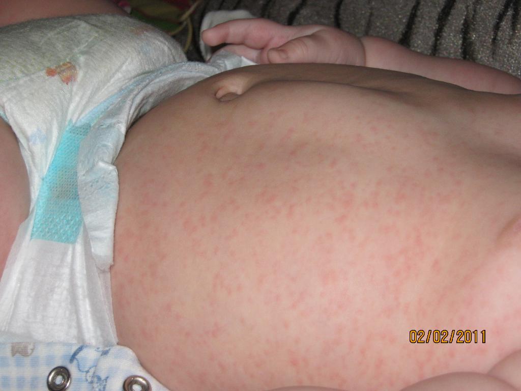 Сыпь-Розеола детская. Павлинчик