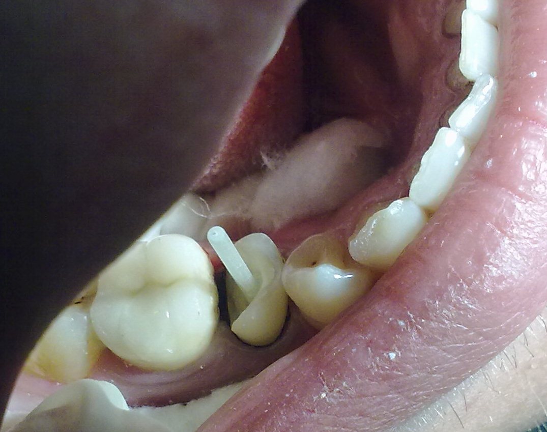 зафиксирован стекловолоконный штифт. СТОМАТОЛОГИЯ-терапия