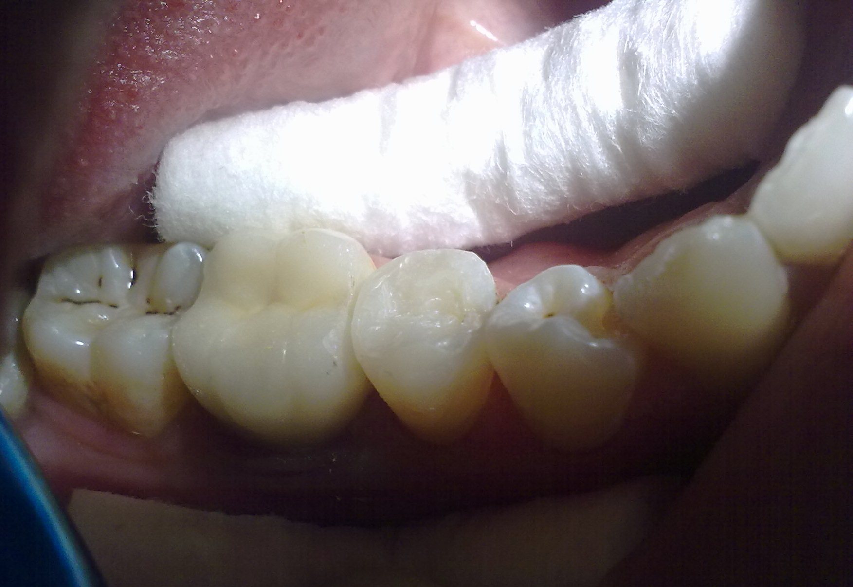 готовая реставрация.. СТОМАТОЛОГИЯ-терапия