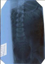 Рентген спины (подозрение на сколиоз)