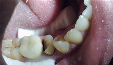 запломбирован канал,зуб до реставрации.