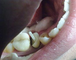 зафиксирован стекловолоконный штифт