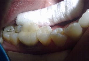 готовая реставрация.